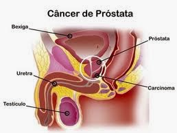 problemas centravanti prostata